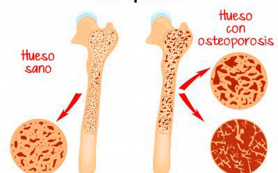 Leche y Osteoporosis