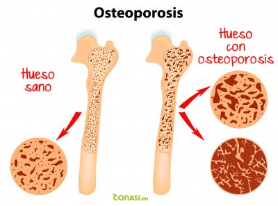 Leche y Osteoporosis