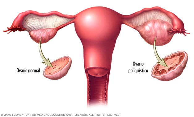 Imagen de un ovario normal y otro poliquístico - Síndrome de Ovario Poliquístico